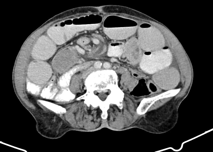Acute small bowel (ileal) volvulus (Radiopaedia 71740-82139 Axial C+ portal venous phase 125).jpg
