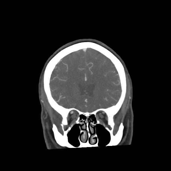 File:Acute subarachnoid hemorrhage and accessory anterior cerebral artery (Radiopaedia 69231-79009 Coronal C+ arterial phase 26).jpg