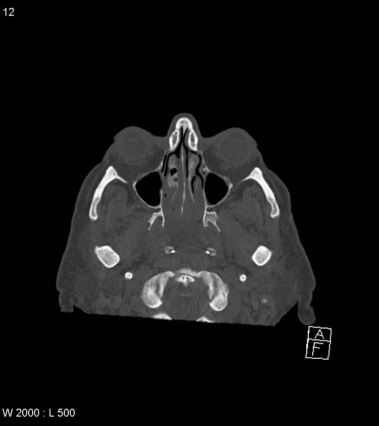 Acute subdural hematoma with myelofibrosis (Radiopaedia 52582-58494 Axial bone window 6).jpg