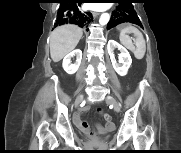 Acute superior mesenteric artery occlusion (Radiopaedia 43926-47418 Coronal C+ portal venous phase 32).png