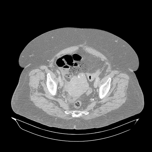 Acute superior mesenteric artery occlusion (Radiopaedia 51288-56960 Axial lung window 66).jpg