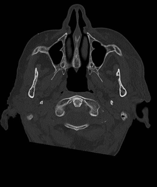 Acute traumatic subdural hematoma (Radiopaedia 82921-97257 Axial bone window 100).jpg
