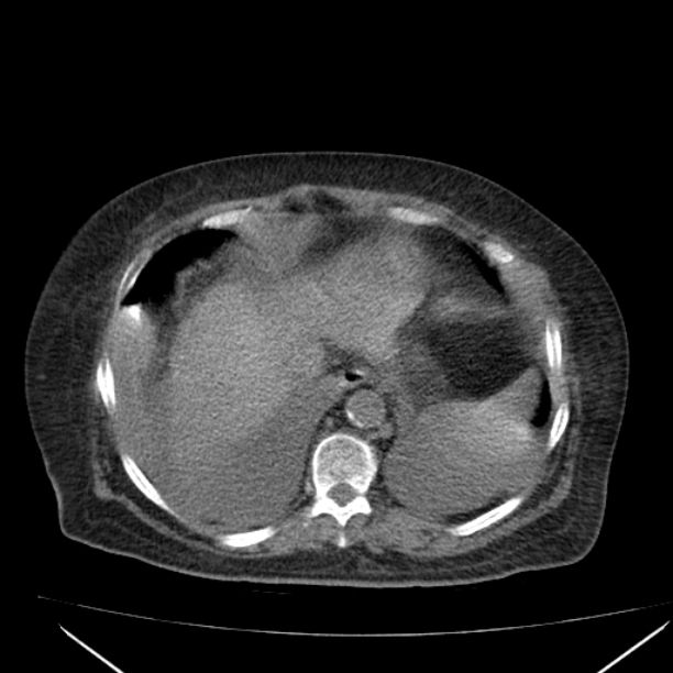 Acute tubular necrosis (Radiopaedia 28077-28334 Axial non-contrast 12).jpg