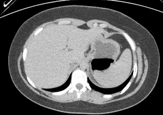 Acute unilateral nonhemorrhagic adrenal infarction (Radiopaedia 67560-76957 Axial renal excretory phase 6).jpg