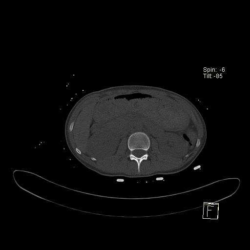 File:Acute vertebral compression fracture (Radiopaedia 63832-72559 Axial bone window 17).jpg