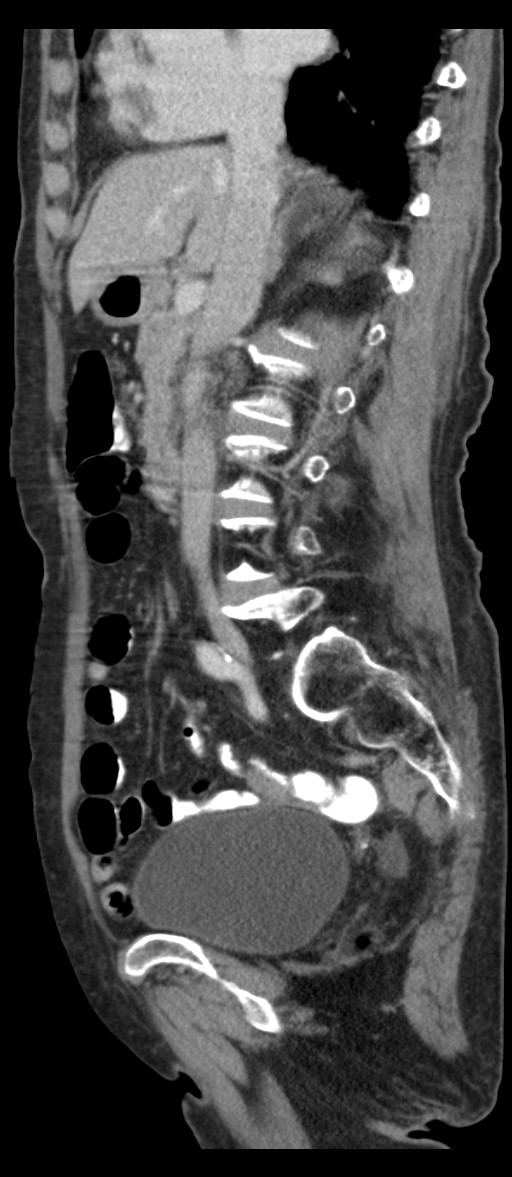 Adenocarcinoma of cecum (Radiopaedia 59222-66549 Sagittal C+ portal venous phase 56).jpg