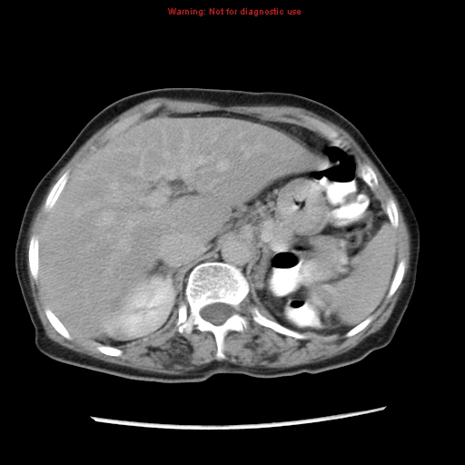 Adenocarcinoma of the colon (Radiopaedia 8191-9039 Axial renal excretory phase 7).jpg