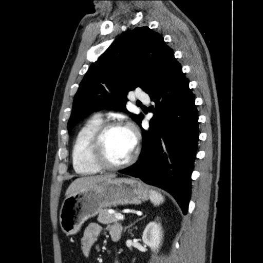 Adenocarcinoma of the lung (Radiopaedia 59871-67325 Coronal lung window 52).jpg