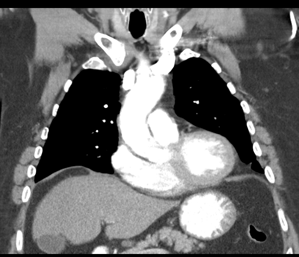 Adenocarcioma of rectum- T1 lesion (Radiopaedia 36921-38547 Coronal C+ arterial phase 25).png