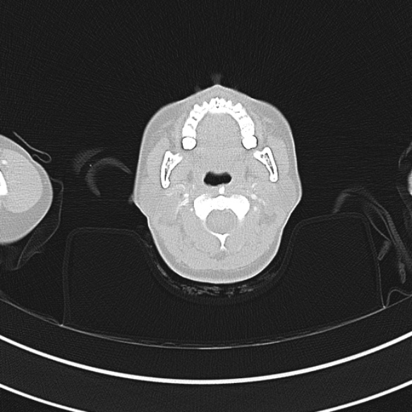 Adenocystic carcinoma of the trachea (Radiopaedia 47677-52525 Axial lung window 9).jpg