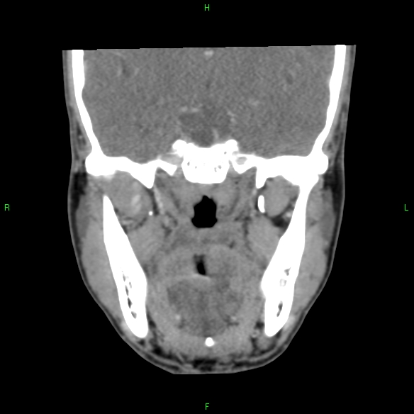 File:Adenoid cystic carcinoma of hard palate (Radiopaedia 26137-26273 Coronal liver window 19).jpg