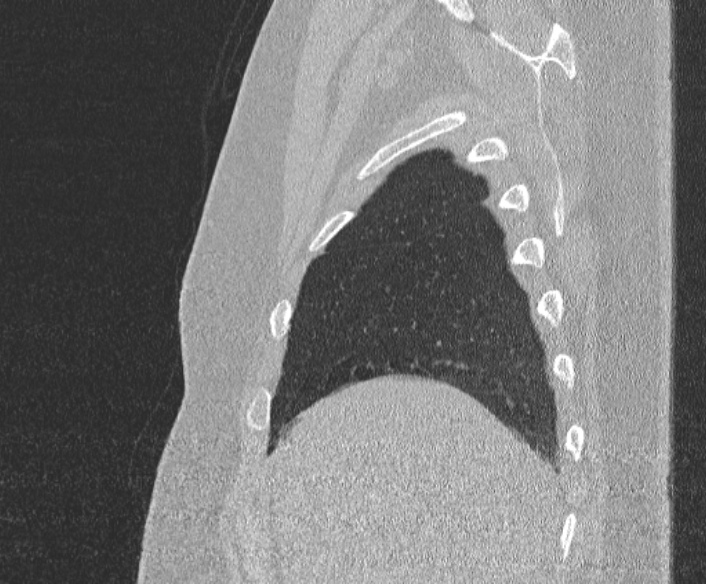 Adenoid cystic carcinoma of the trachea (Radiopaedia 49042-54137 Sagittal lung window 71).jpg