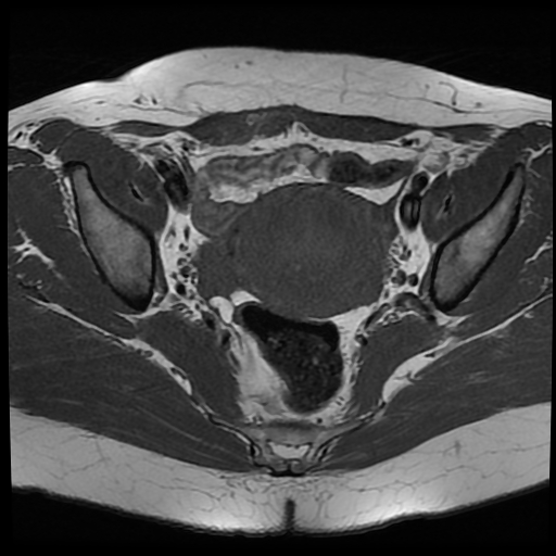 File:Adenomyosis-scar endometriosis (Radiopaedia 65863-75022 Axial T1 16).jpg