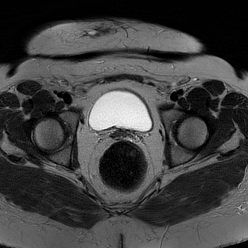 File:Adenomyosis within a didelphys uterus (Radiopaedia 70175-80215 Axial T2 26).jpg