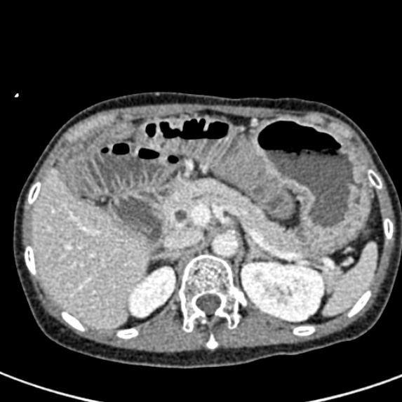 Adhesional small bowel obstruction (Radiopaedia 48397-53305 Axial C+ portal venous phase 18).jpg