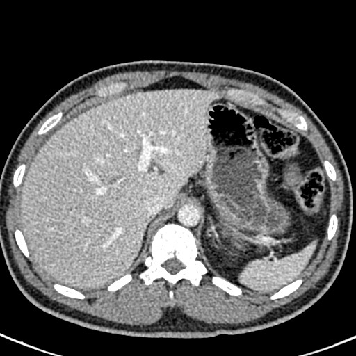 Adhesional small bowel obstruction (Radiopaedia 58900-66131 Axial C+ portal venous phase 11).jpg