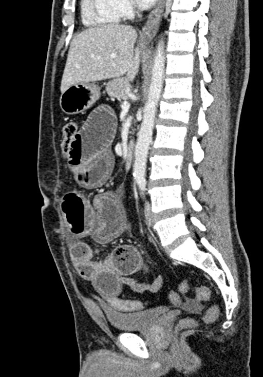 Adhesional small bowel obstruction (Radiopaedia 58900-66131 Sagittal C+ portal venous phase 131).jpg