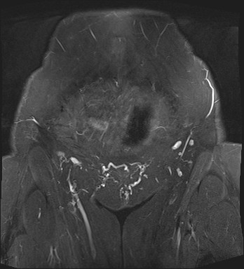 File:Adnexal multilocular cyst (O-RADS US 3- O-RADS MRI 3) (Radiopaedia 87426-103754 Coronal T2 fat sat 3).jpg