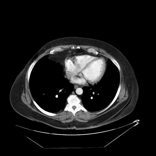 Adrenal angiosarcoma (Radiopaedia 81081-94671 Axial C+ arterial phase 3).jpg