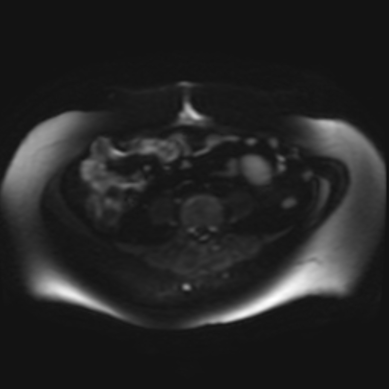 Adrenal cortical carcinoma (Radiopaedia 70906-81116 Axial DWI 26).jpg