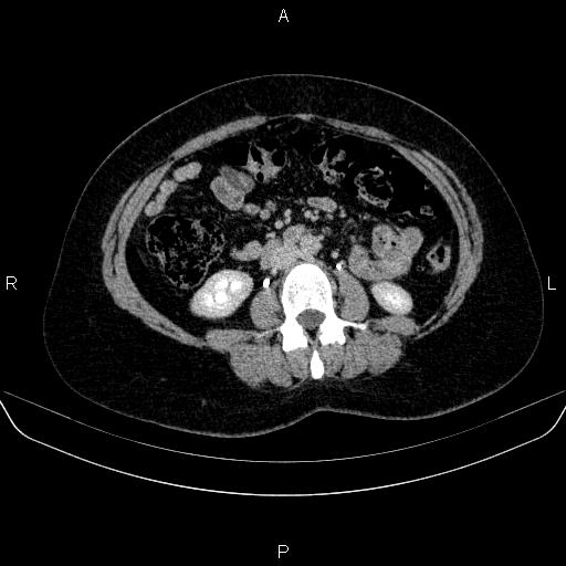 Adrenal cortical carcinoma (Radiopaedia 84882-100379 Axial C+ delayed 45).jpg