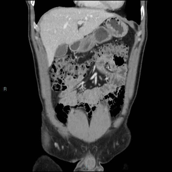 Adrenal cystic lymphangioma (Radiopaedia 83161-97534 Coronal C+ portal venous phase 21).jpg