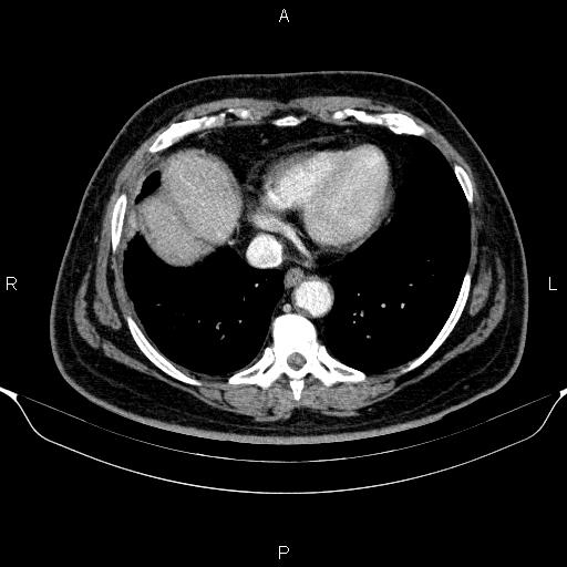 Adrenal hemorrhage (Radiopaedia 62622-70916 Axial C+ portal venous phase 7).jpg