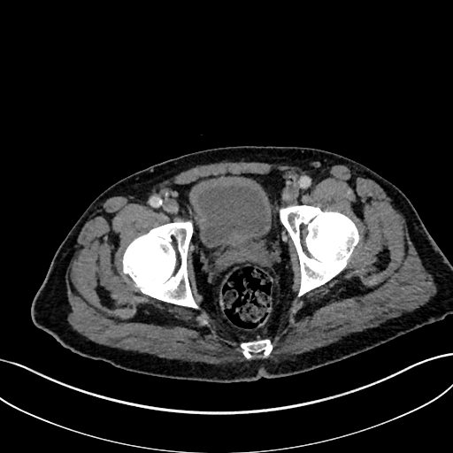 File:Adrenal lymphoma (Radiopaedia 73730-84529 Axial C+ portal venous phase 118).jpg