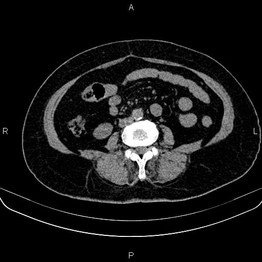 Adrenal myelolipoma (Radiopaedia 82742-96986 Axial non-contrast 94).jpg