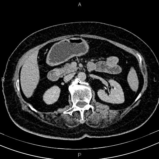 Adrenal myelolipoma (Radiopaedia 82742-96986 Axial renal excretory phase 56).jpg