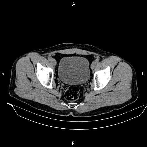 File:Adrenal myelolipoma (Radiopaedia 87794-104246 Axial non-contrast 96).jpg