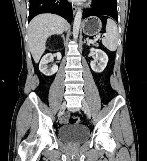 Adrenal myelolipoma (Radiopaedia 87794-104246 Coronal renal cortical phase 38).jpg