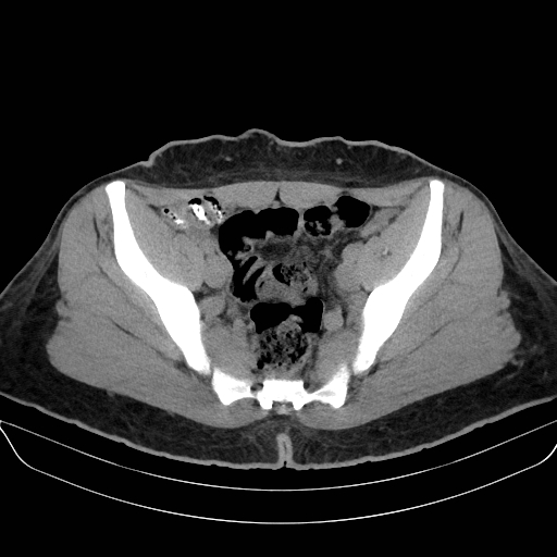 File:Adrenal myelolipoma - bilateral (Radiopaedia 74805-85810 Axial non-contrast 68).jpg