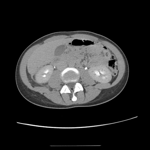 Adult polycystic kidney disease (Radiopaedia 48845-53876 Axial renal excretory phase 49).jpg