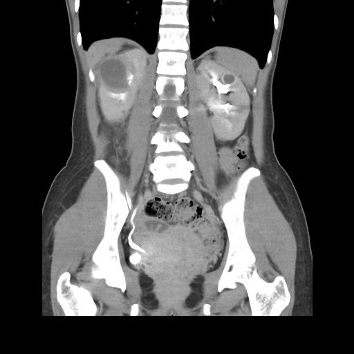 File:Adult polycystic kidney disease (Radiopaedia 48845-53876 Coronal renal excretory phase 29).jpg