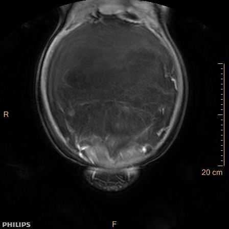 Aggressive angiomyxoma (Radiopaedia 73343-84093 G 19).jpg