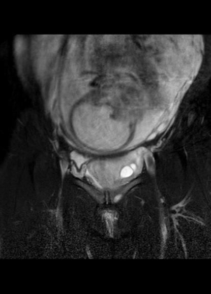 File:Aggressive angiomyxoma of the pelvis and perineum (Radiopaedia 59162-66479 Coronal T2 fat sat 7).jpg