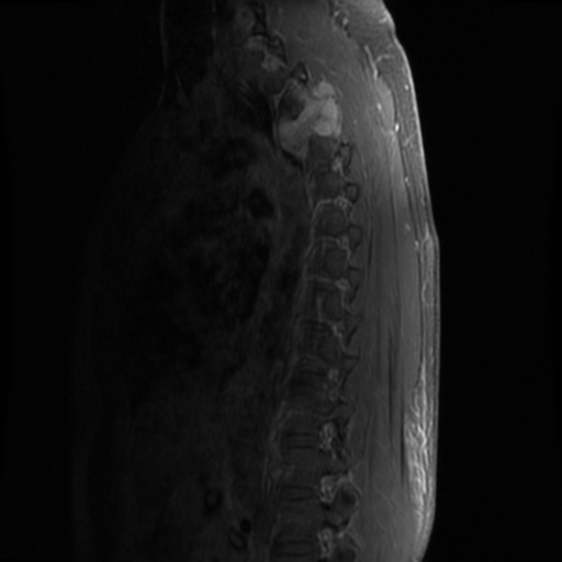 File:Aggressive vertebral hemangioma (Radiopaedia 39937-42404 B 8).png