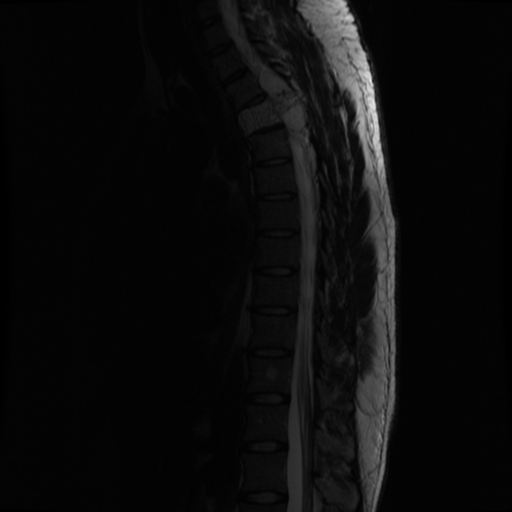 File:Aggressive vertebral hemangioma (Radiopaedia 39937-42404 Sagittal T2 7).png