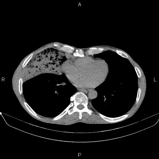 File:Air bronchogram in pneumonia (Radiopaedia 85719-101512 Axial non-contrast 45).jpg