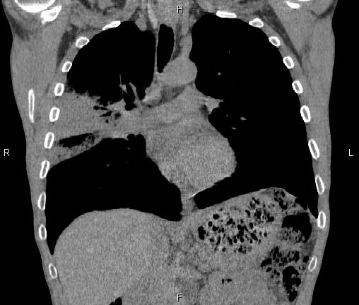 Air bronchogram in pneumonia (Radiopaedia 85719-101512 Coronal non-contrast 28).jpg