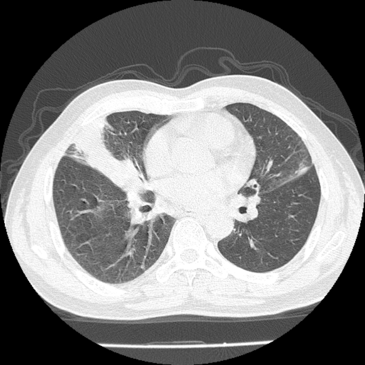 Airway foreign body in adult (Radiopaedia 85907-101779 Axial lung window 101).jpg
