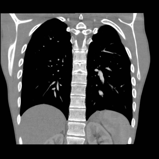 File:Alagille syndrome with pulmonary hypertension (Radiopaedia 49384-54980 C 9).jpg