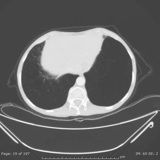 Alpha-1-antitrypsin deficiency (Radiopaedia 50561-55987 Axial lung window 8).jpg