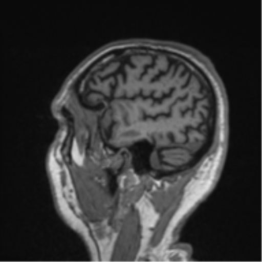 Alzheimer's disease- with Gerstmann syndrome and dressing apraxia (Radiopaedia 54882-61150 Sagittal T1 60).png