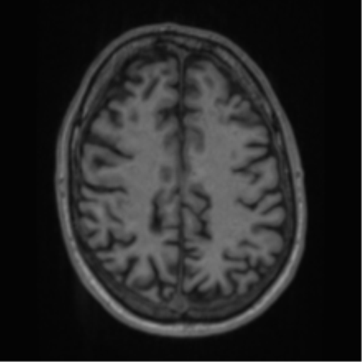Alzheimer's disease- with apraxia (Radiopaedia 54763-61011 Axial T1 53).png