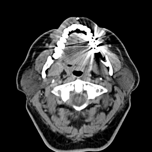Ameloblastoma (Radiopaedia 38520-40623 Axial non-contrast 25).png