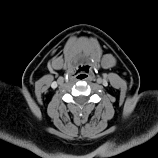 Ameloblastoma (Radiopaedia 38520-40623 Axial non-contrast 42).png