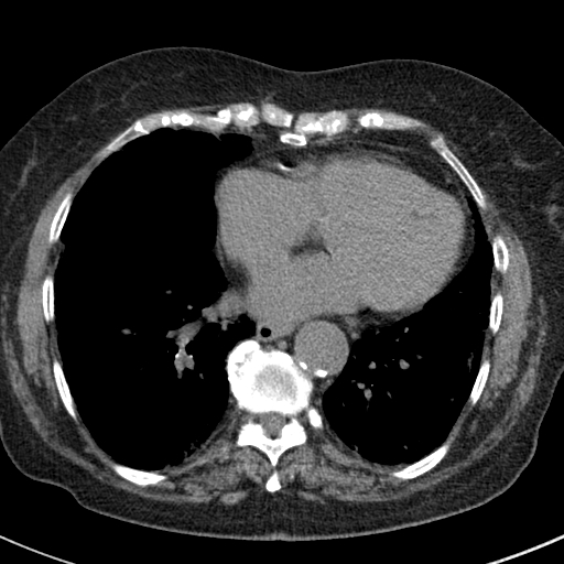 File:Amiodarone-induced pulmonary fibrosis (Radiopaedia 82355-96460 Axial non-contrast 41).jpg