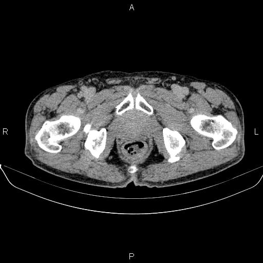 Ampullary adenocarcinoma (Radiopaedia 86093-102032 Axial C+ delayed 107).jpg